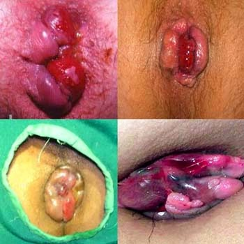 Illustration for article titled Cara mengatasi benjolan kecil di mulut anus